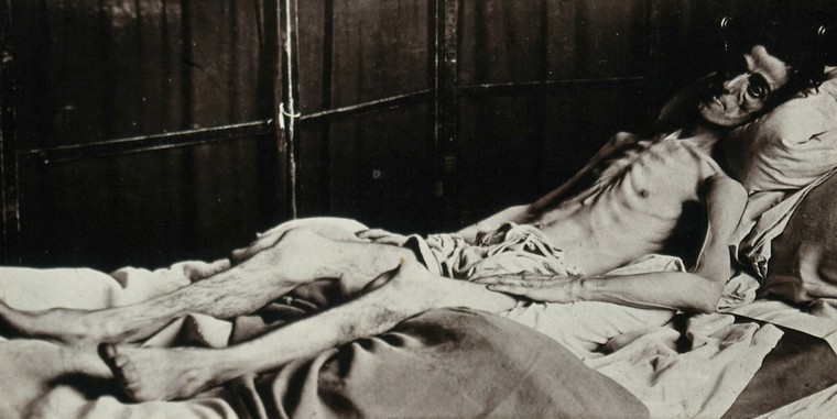 A man dying of type 1 diabetes before insulin